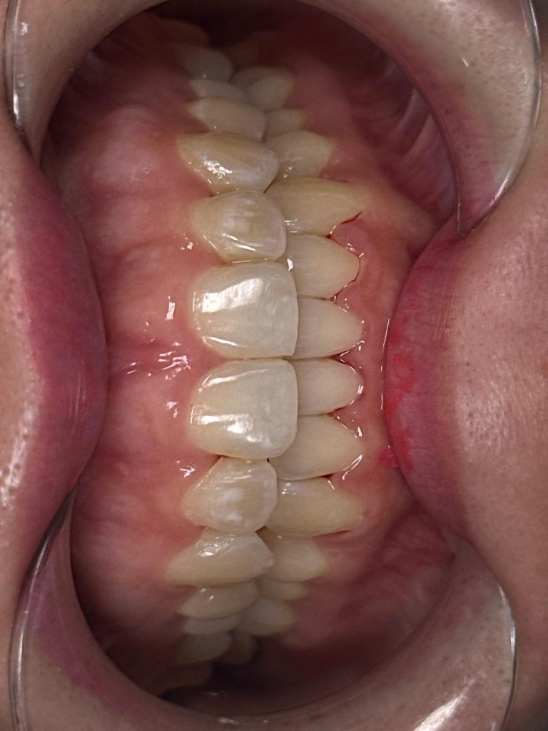 Smile transformation case 4 — after treatment