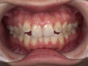 Smile transformation case 4 — before treatment