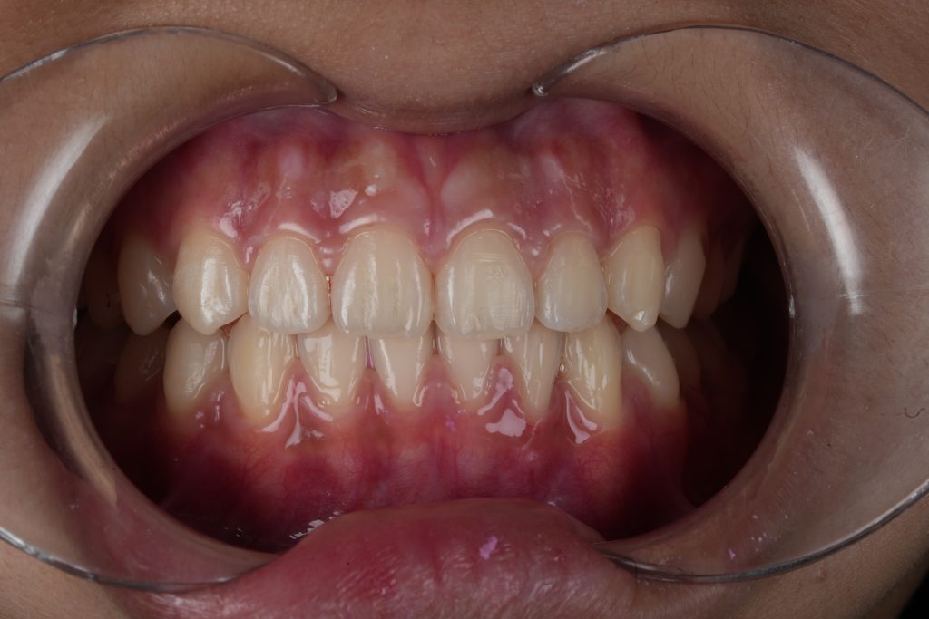 Smile transformation case 5 — after treatment