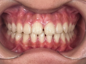 Smile transformation case 5 — before treatment