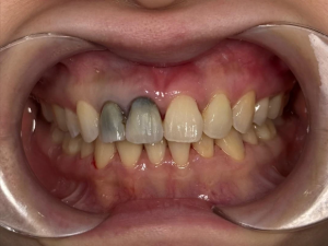 Smile transformation case 2 — before treatment