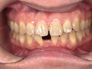 Smile transformation case 3 — before treatment