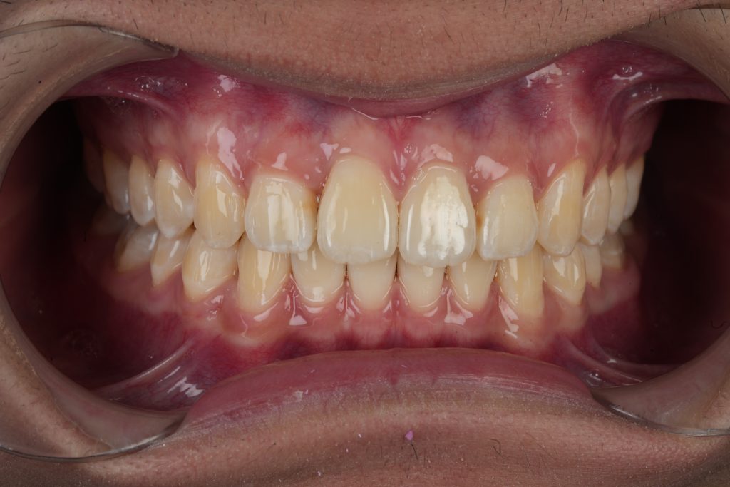 Smile transformation case 1 — after treatment
