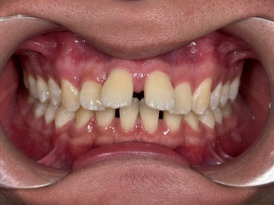 Smile transformation case 1 — before treatment