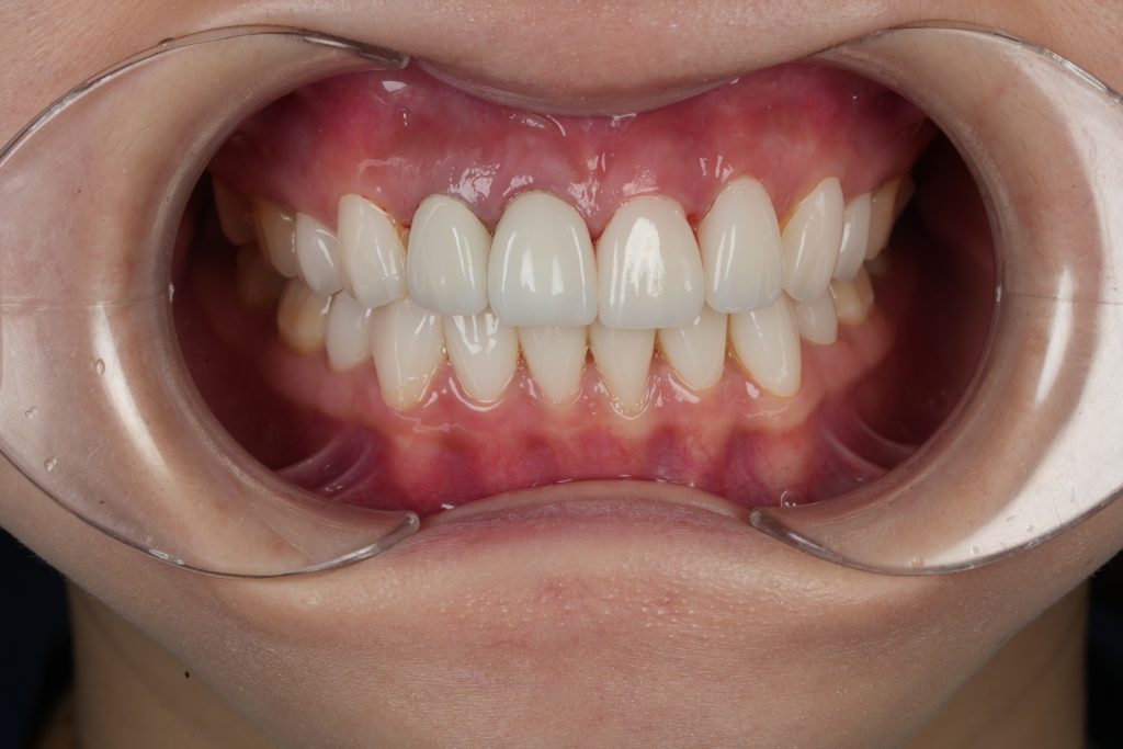 Smile transformation case 2 — after treatment